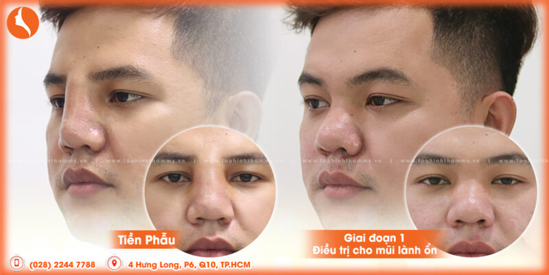 Trước và sau giai đoạn 1: Điều trị mũi hỏng