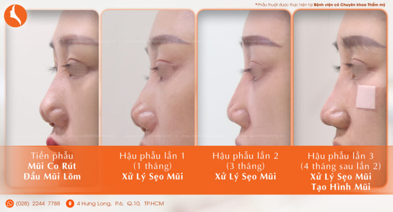 3 giai đoạn điều trị mũi hỏng nặng