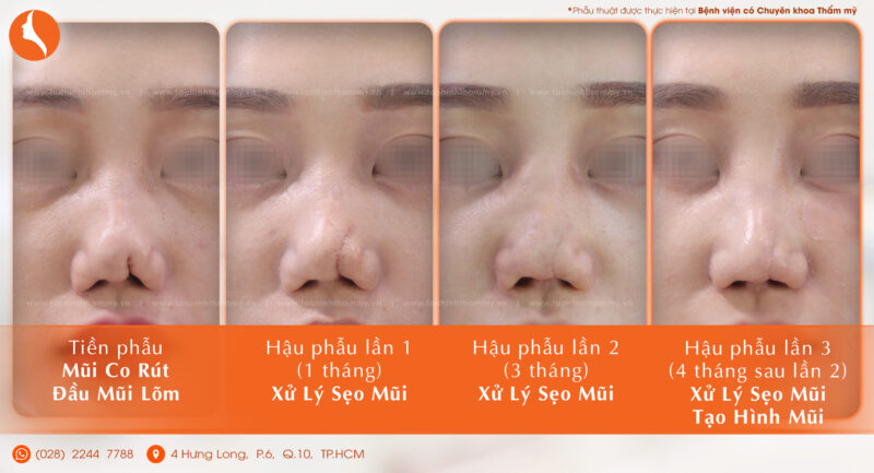 điều trị mũi hỏng 3 giai đoạn
